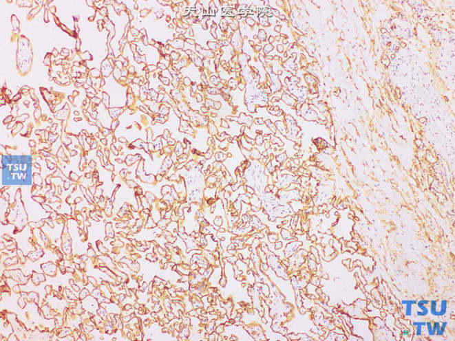附睾硬化性血管瘤，免疫组化：CD34（+）