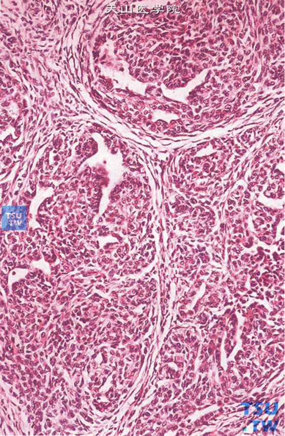 附睾腺癌。肿瘤呈小管、小管-乳头状结构