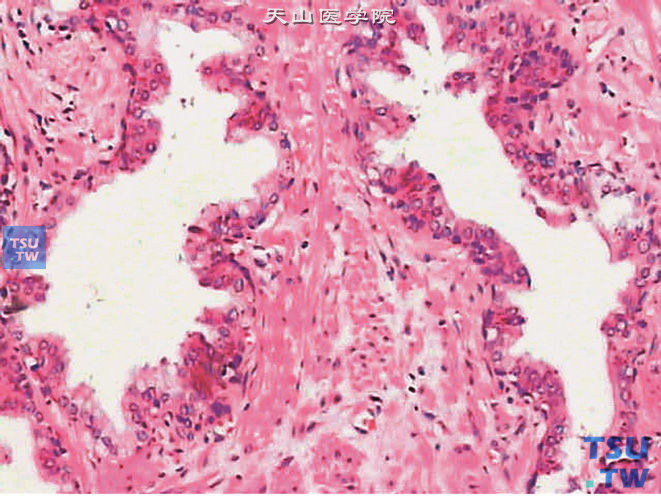 正常前列腺，腺体腔面呈波浪状或齿轮状