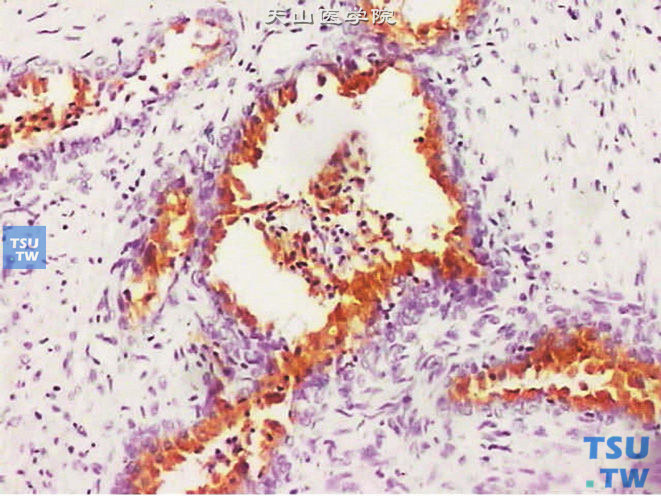 正常前列腺，腺体腔面上皮PSA染色阳性