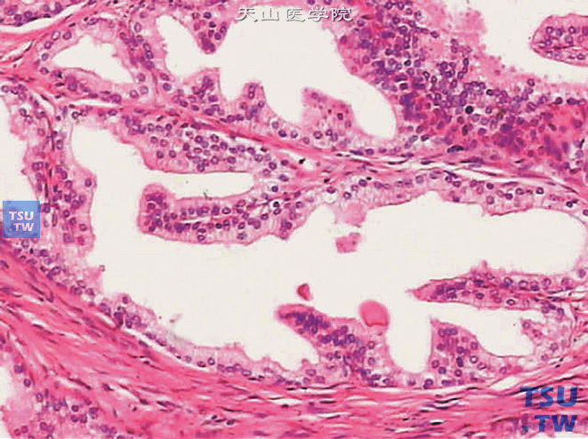 正常前列腺，凸入腺腔有纤维血管轴心的乳头（上图高位）