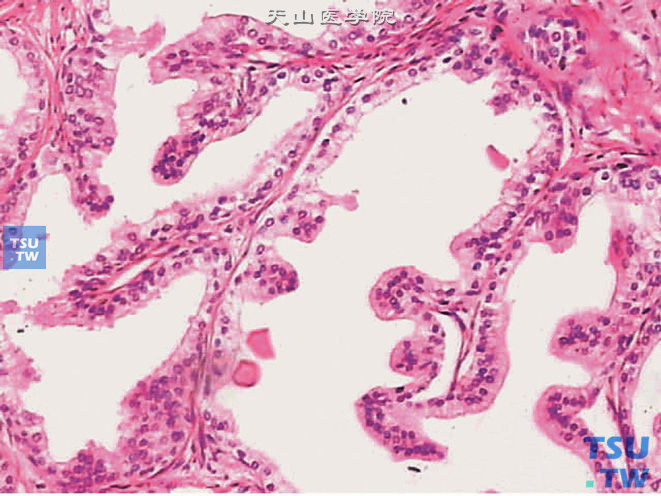正常前列腺，凸入腺腔有纤维血管轴心的乳头