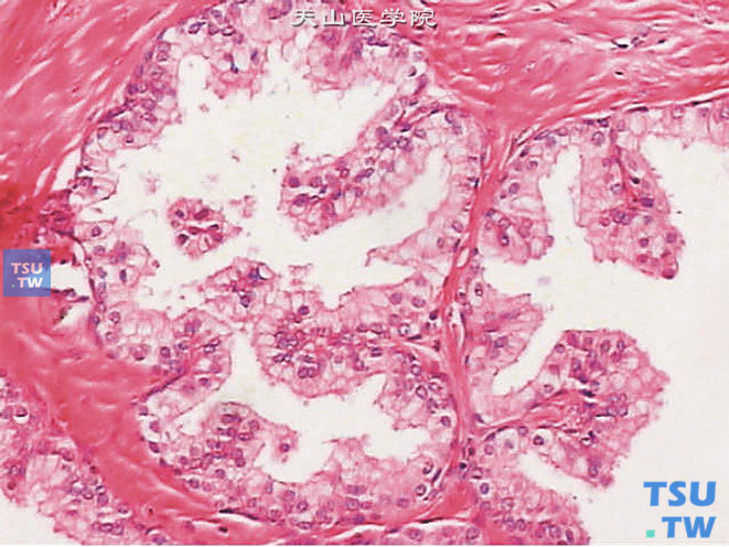 正常前列腺，凸入腺腔有纤维血管轴心的乳头