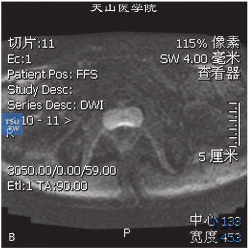 图B：CT，正常前列腺。前列腺体积不大，外周带及中央腺体显示清晰，未见异常信号，被膜光整，精囊腺内未见异常信号