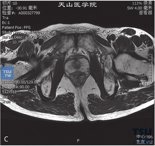 前列腺正常CT影像