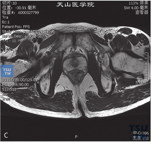 图C：CT，正常前列腺。前列腺体积不大，外周带及中央腺体显示清晰，未见异常信号，被膜光整，精囊腺内未见异常信号