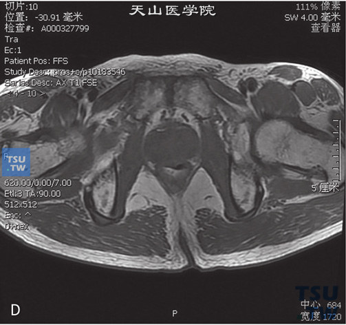 图D：CT，正常前列腺。前列腺体积不大，外周带及中央腺体显示清晰，未见异常信号，被膜光整，精囊腺内未见异常信号