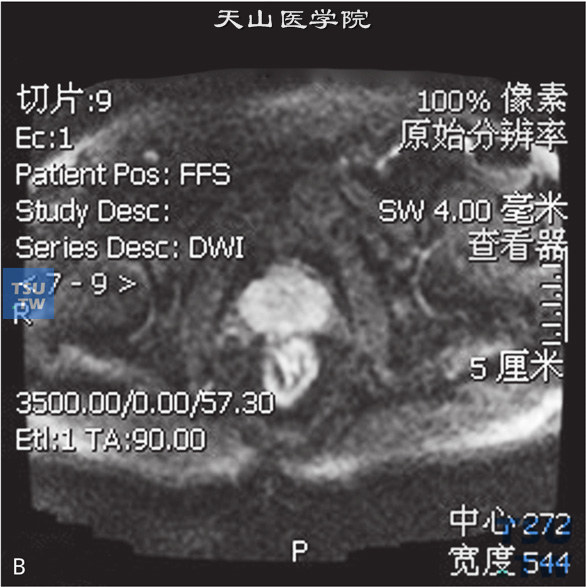 图B：CT，前列腺炎，男，32岁，尿频、尿急1周。前列腺不大，被膜光整，外周带见不规则斑片状T2WI低信号T1WI等信号灶，DWI未见明显异常信号，动态增强曲线为平台型