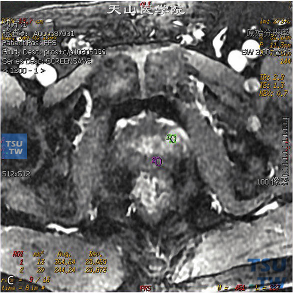 图C：CT，前列腺炎，男，32岁，尿频、尿急1周。前列腺不大，被膜光整，外周带见不规则斑片状T2WI低信号T1WI等信号灶，DWI未见明显异常信号，动态增强曲线为平台型