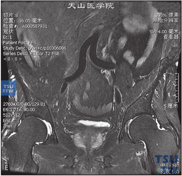 图E：CT，前列腺炎，男，32岁，尿频、尿急1周。前列腺不大，被膜光整，外周带见不规则斑片状T2WI低信号T1WI等信号灶，DWI未见明显异常信号，动态增强曲线为平台型