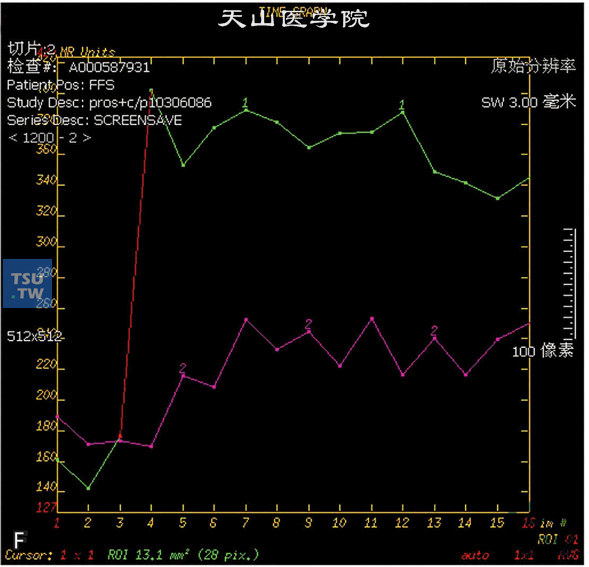 图F：CT，前列腺炎，男，32岁，尿频、尿急1周。前列腺不大，被膜光整，外周带见不规则斑片状T2WI低信号T1WI等信号灶，DWI未见明显异常信号，动态增强曲线为平台型