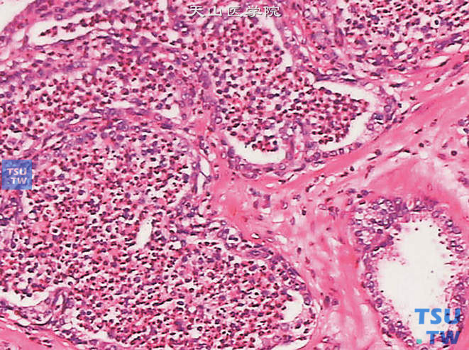 急性前列腺炎。上图高倍，示腺腔内可见中性粒细胞，部分上皮细胞破坏