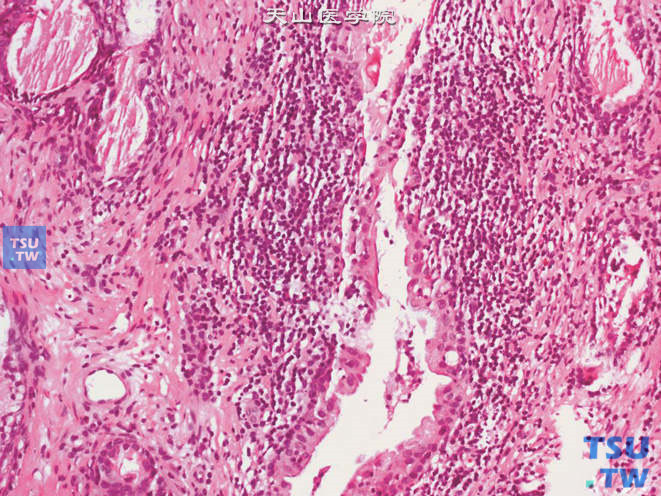 慢性非特异性前列腺炎，腺体周围可见以淋巴细胞为主的炎细胞浸润
