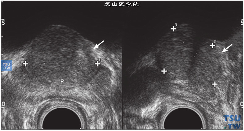 前列腺增生的超声图像表现非常丰富，其中包括前列腺增生本身的病理改变，也有许多并发症的病变。前列腺体积大小不一，可表现为不同程度的增大，外形饱满，但被膜光滑完整，移行区内出现大小不等的增生结节，结节外形规则，严重时前列腺向膀胱内凸入，前列腺尿道受压，引起排尿困难。移行区后缘常见到弧形排列的多发小结石，腺体内也常见多发性小囊肿。前列腺增生可同时合并膀胱壁损害，膀胱呈小梁小房及膀胱憩室改变，双肾及输尿管扩张、积水甚至肾损害，可合并膀胱结石