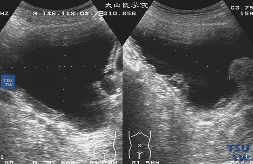 良性前列腺增生合并尿潴留超声图像特点：前列腺增生导致下尿路长期梗阻，慢性尿潴留，该病例残余尿大于300ml