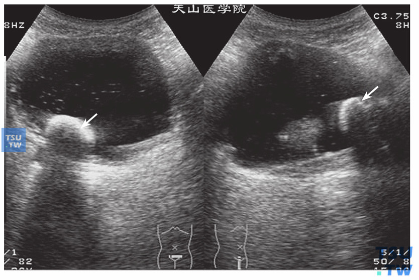 良性前列腺增生合并膀胱结石超声图像特点：前列腺增生合并膀胱结石很常见。超声中在膀胱腔内可见到单发或多发强回声光团，多发更常见，最大的特点是强光团可随体位移动（箭头指示）