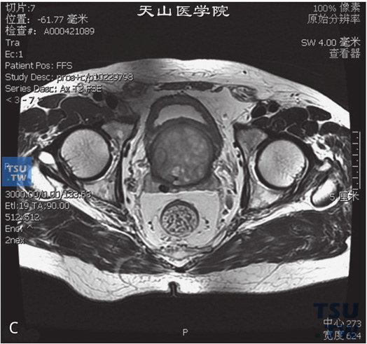 图C：CT，前列腺增生，男，55岁，排尿困难，PSA轻度升高。前列腺中央腺体增大，内部见多发结节状T1WI等T2WI等或高信号灶，外周带受压，DWI未见异常信号。前列腺被膜光整。前列腺于膀胱三角区压迫膀胱略内陷。右侧精囊腺间结节状T2WI低T1WI稍低信号灶，边缘清晰。考虑为钙化可能大