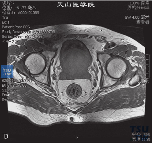 图D：CT，前列腺增生，男，55岁，排尿困难，PSA轻度升高。前列腺中央腺体增大，内部见多发结节状T1WI等T2WI等或高信号灶，外周带受压，DWI未见异常信号。前列腺被膜光整。前列腺于膀胱三角区压迫膀胱略内陷。右侧精囊腺间结节状T2WI低T1WI稍低信号灶，边缘清晰。考虑为钙化可能大