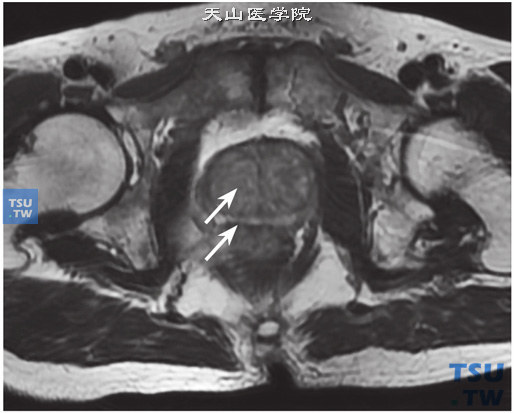 核磁，T2WI中央腺体体积增大（上箭），信号不均匀，双侧外周带受压变薄（下箭）