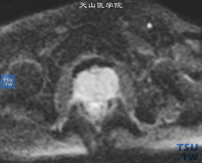 核磁，DWI增大的中央腺体呈稍高信号