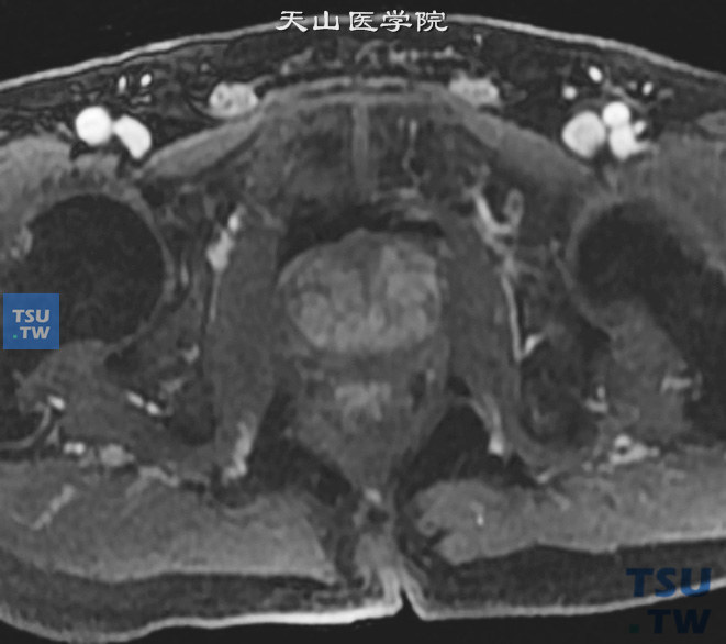 前列腺增生CT图片