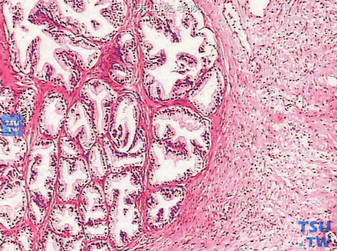 腺肌纤维瘤型（混合型）增生，以腺体增生为主，此型最为多见。结节的边界较清楚，圆或椭圆形。增生的腺体成分呈大小不等的腺泡，被覆柱状上皮和基底细胞。腺体周围有平滑肌或纤维性间质包绕