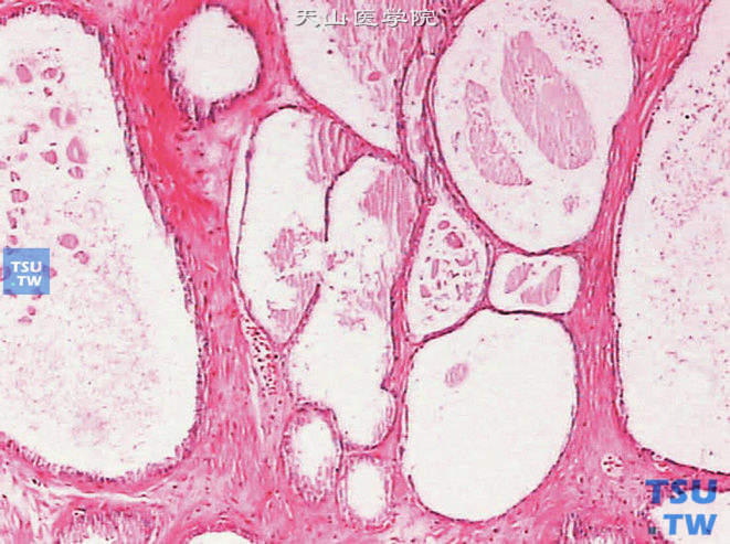 腺肌纤维瘤型（混合型）增生，示结节中的腺体萎缩扩张，腺腔增大，上皮趋于扁平