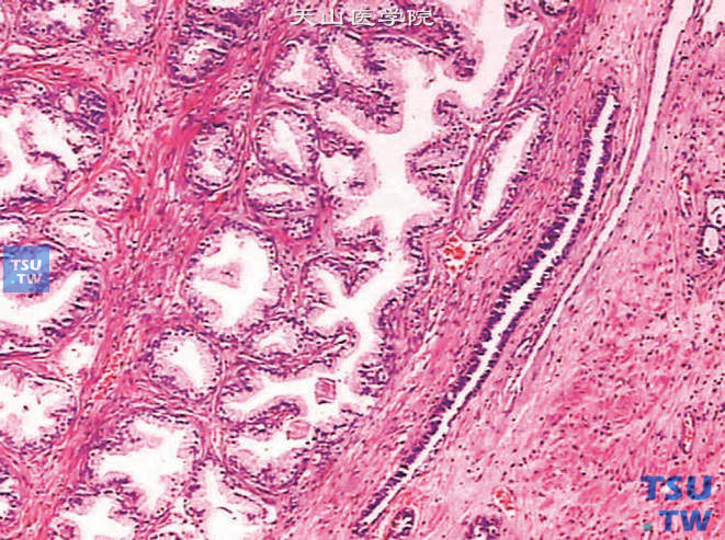 腺肌纤维瘤型（混合型），以腺体增生为主，增生的腺体具有非同步性增生的特征并呈中心趋向性：腺体靠近边缘侧的乳头较平缓而靠近中心侧乳头较突出