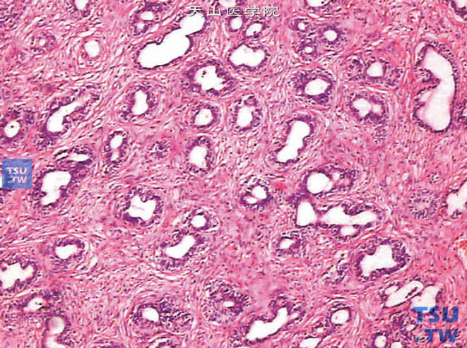腺肌纤维瘤型（混合型）增生，以间质增生为主，形态类似于乳腺纤维腺瘤，大量间质组织围绕较小的、散在分布的腺体