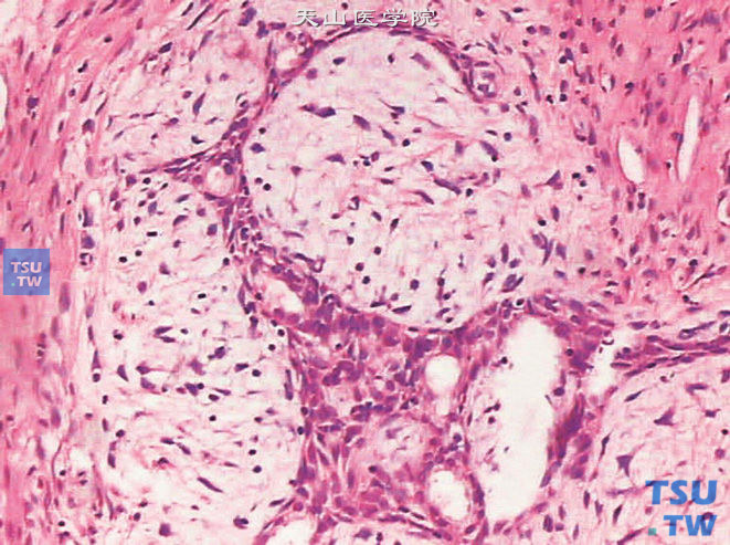 腺肌纤维瘤型（混合型）增生，上图高倍，示裂隙状腺体