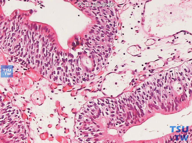 基底细胞增生，上图高倍，示中心部分可见腺上皮被覆，呈单层立方或柱状