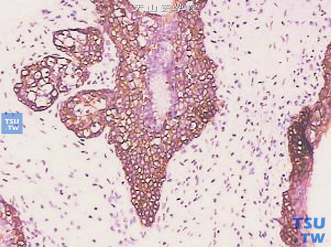 基底细胞增生，免疫组化：34βE12多层增生的基底细胞阳性，腺腔中心的腺上皮阴性