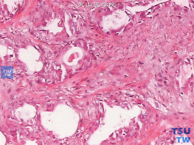 不典型基底细胞增生，此例患者为前列腺癌放疗后，可见基底细胞增大，出现核仁