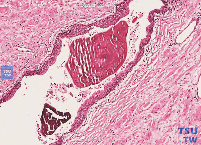 尿路上皮化生，前列腺导管的周围段及前列腺腺泡内出现尿路上皮被覆为尿路上皮化生。腔内可见小钙化石。常因炎症刺激等因素所致