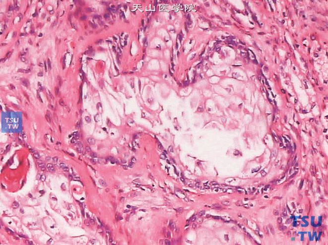鳞状上皮化生，在腺体中出现成片的鳞状上皮细胞