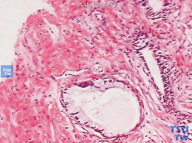 黏液腺化生，一般为肠腺化生，腺管的细胞呈高柱状，有较多含黏液的杯状细胞，细胞核位于基底部