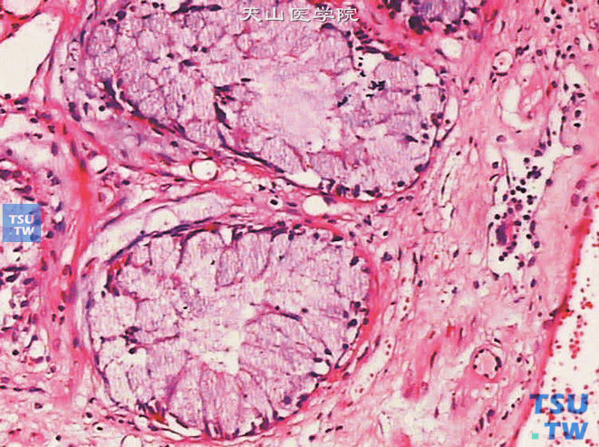 黏液腺化生，上图高倍，示含黏液的杯状细胞，细胞核位于基底部