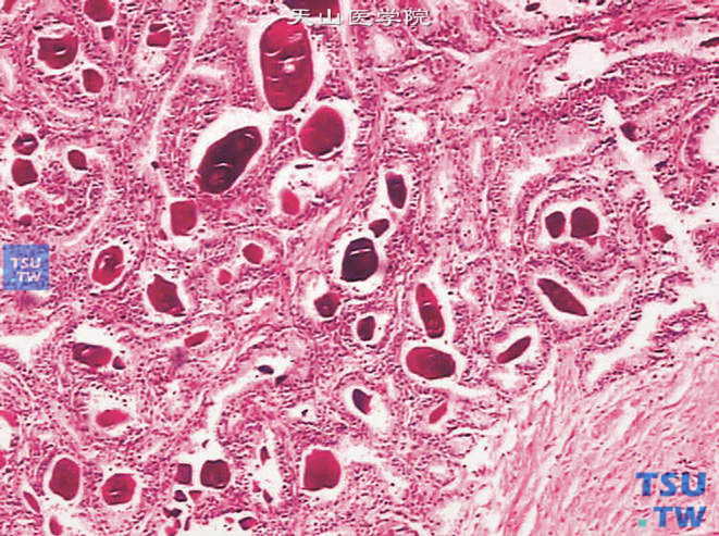 淀粉样小体，为存在于前列腺腺体内的圆形嗜酸性小体，呈同心的层状结构