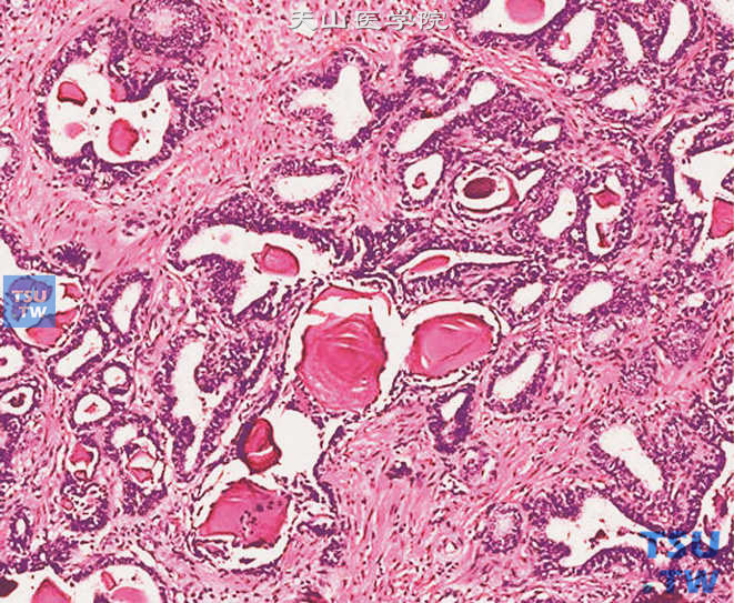 结石，多位于前列腺的大导管或囊腔中，为淀粉样小体的浓缩钙化或沉淀的前列腺分泌物的钙化。镜下呈同心层状，圆形或椭圆形钙化的淀粉样小体