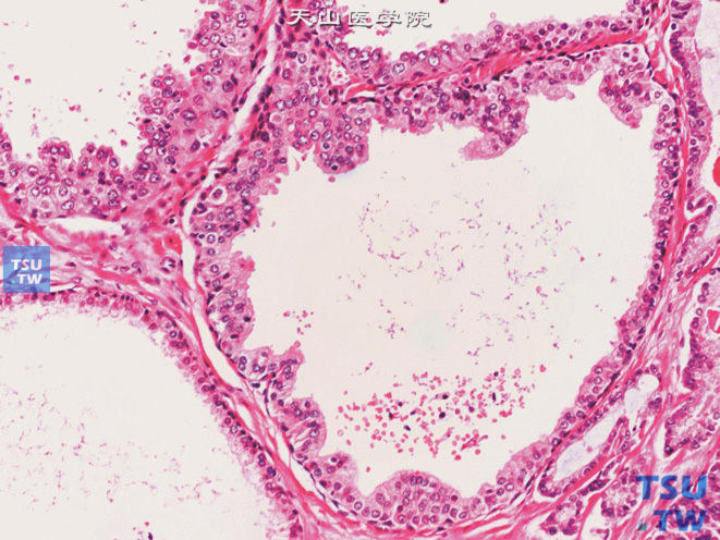 前列腺上皮内瘤变（PIN），低级别，上皮细胞拥挤，呈簇状增生，腔面不规则