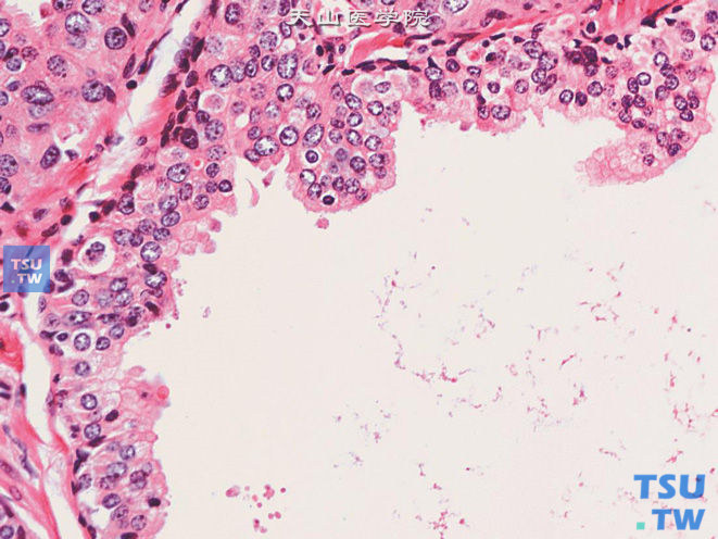 前列腺上皮内瘤变（PIN），低级别，（上图高倍）示核染色质基本正常，核仁小而不显著