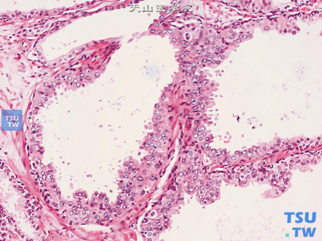 前列腺上皮内瘤变（PIN），低级别，上皮细胞拥挤，呈簇状增生，腔面不规则，细胞核大小不一，可见不规则浓染的核及小核仁