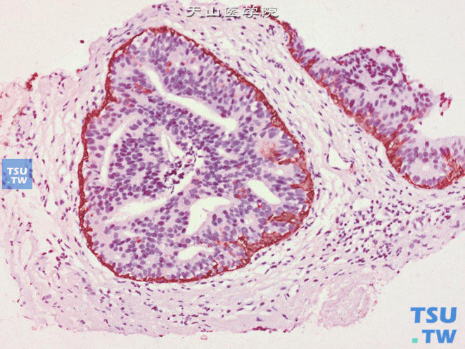 前列腺穿刺标本中高级别PIN。上皮增生呈筛状，基底细胞层完整，免疫组化34βE12 （+）