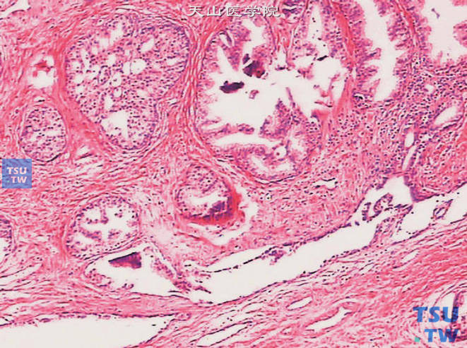 前列腺上皮内瘤变 （PIN），高级别。示筛状结构。本例伴偶发癌