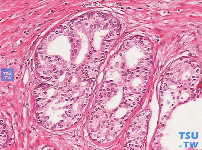 前列腺上皮内瘤变（PIN），高级别，（上图高倍），示筛状结构。本例伴偶发癌