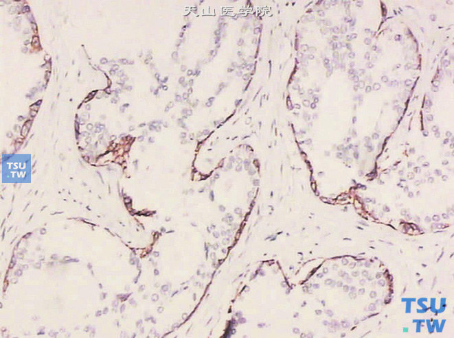 前列腺上皮内瘤变（PIN），高级别，免疫组化：34βE12 （+）