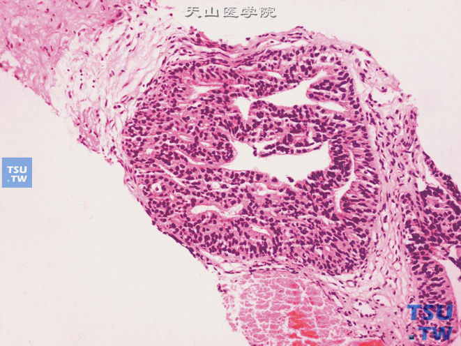 前列腺穿刺标本中高级别PIN。上皮增生呈筛状，基底细胞层完整