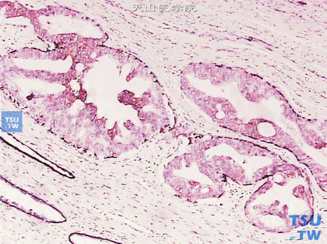 前列腺高级别PIN，免疫组化：34βE12 （+）