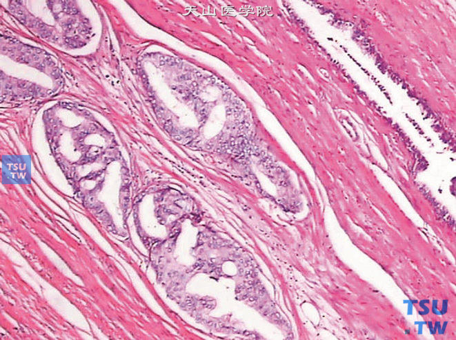 前列腺高级别PIN，呈筛状，细胞核大，有偏心的核仁