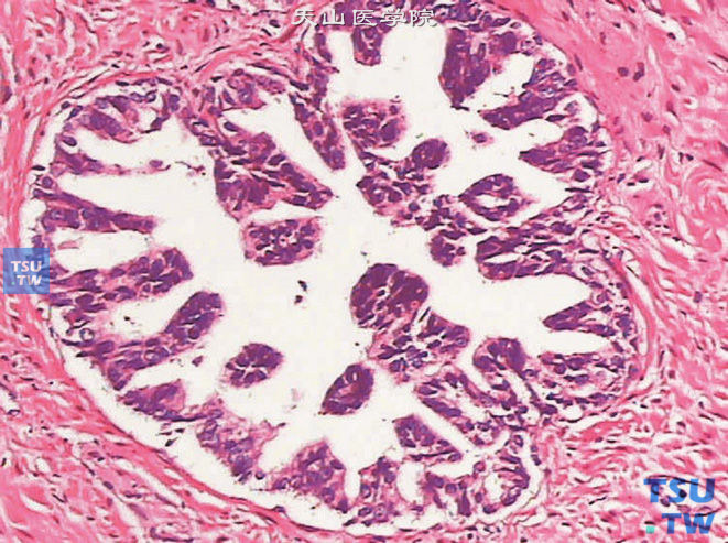 前列腺高级别PIN，微乳头型。分泌细胞层拥挤，有明显的核重叠